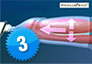 The PHALLOSAN® extender also enlarges the head of the penis (glans)
