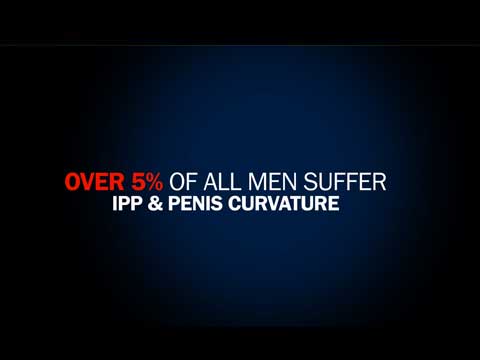 Induratio penis plastica, IPP