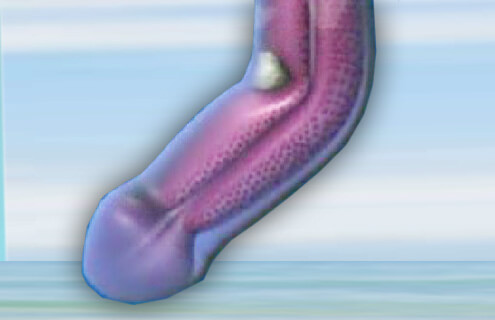 อวัยวะเพศชายโค้งงอ