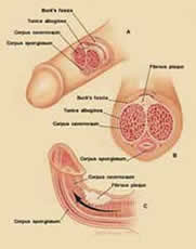 hypoplasia penis, microphallia jelentése magyarul